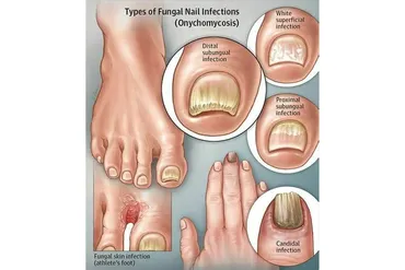 [Sigh Energy] Удаление грибковых ногтей | Fungal Nails Removal Powerful Plus +11x(Extra Strong)