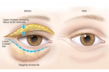 [Sigh Energy] Удаление мешков и жира вокруг глаз