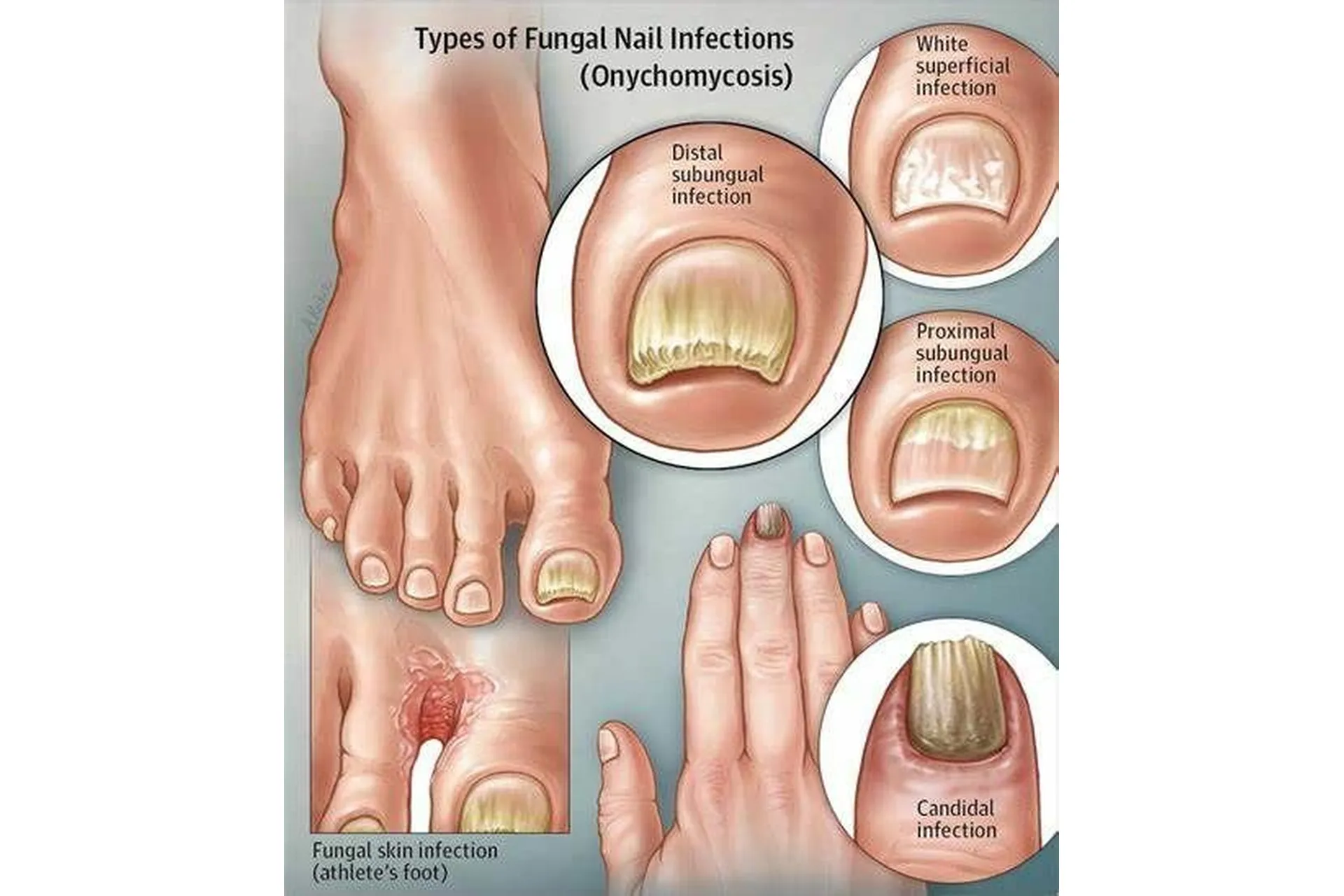 [Sigh Energy] Удаление грибковых ногтей | Fungal Nails Removal Powerful Plus +11x(Extra Strong), фото 1 из 1.