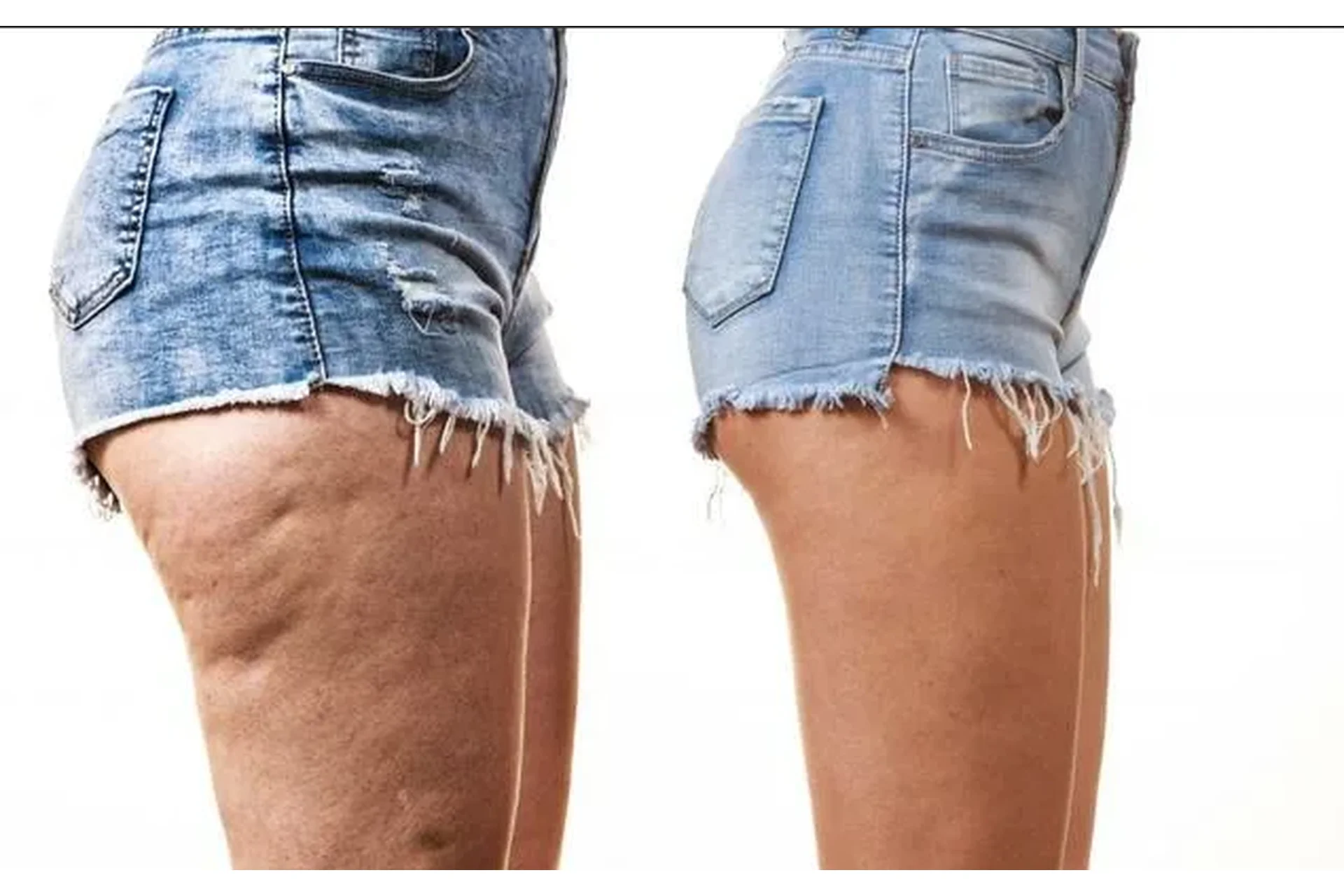 Как самостоятельно избавиться от целлюлита за 2 месяца (Ирина Портнягина), фото 1 из 1.