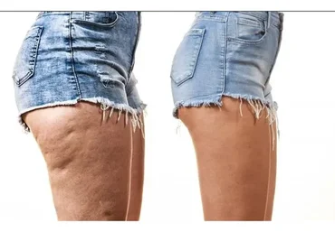 Как самостоятельно избавиться от целлюлита за 2 месяца (Ирина Портнягина)