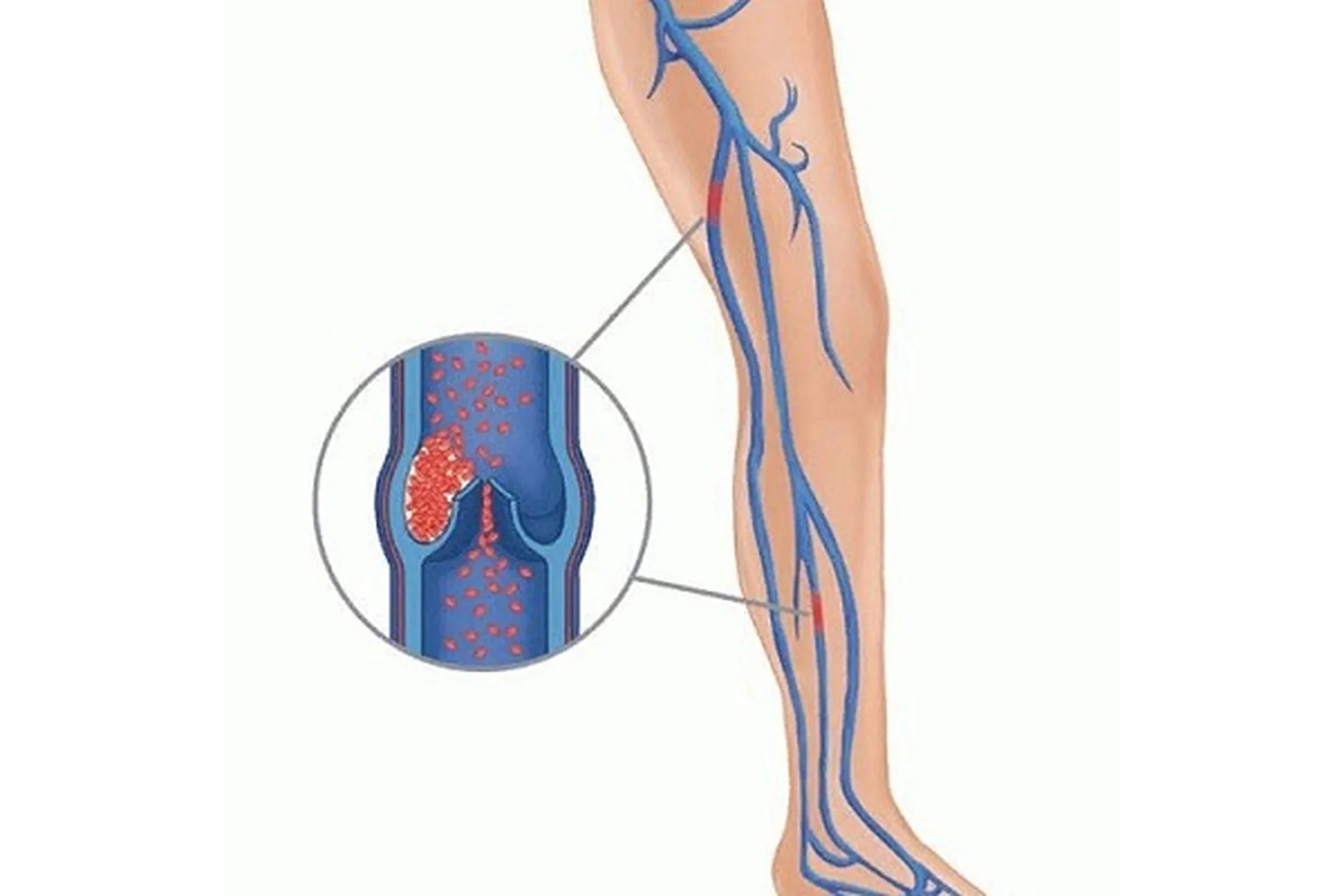[Интераура] Лечение и профилактика: Тромбоз, 2015, фото 1 из 1.