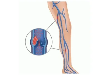 [Интераура] Лечение и профилактика: Тромбоз, 2015