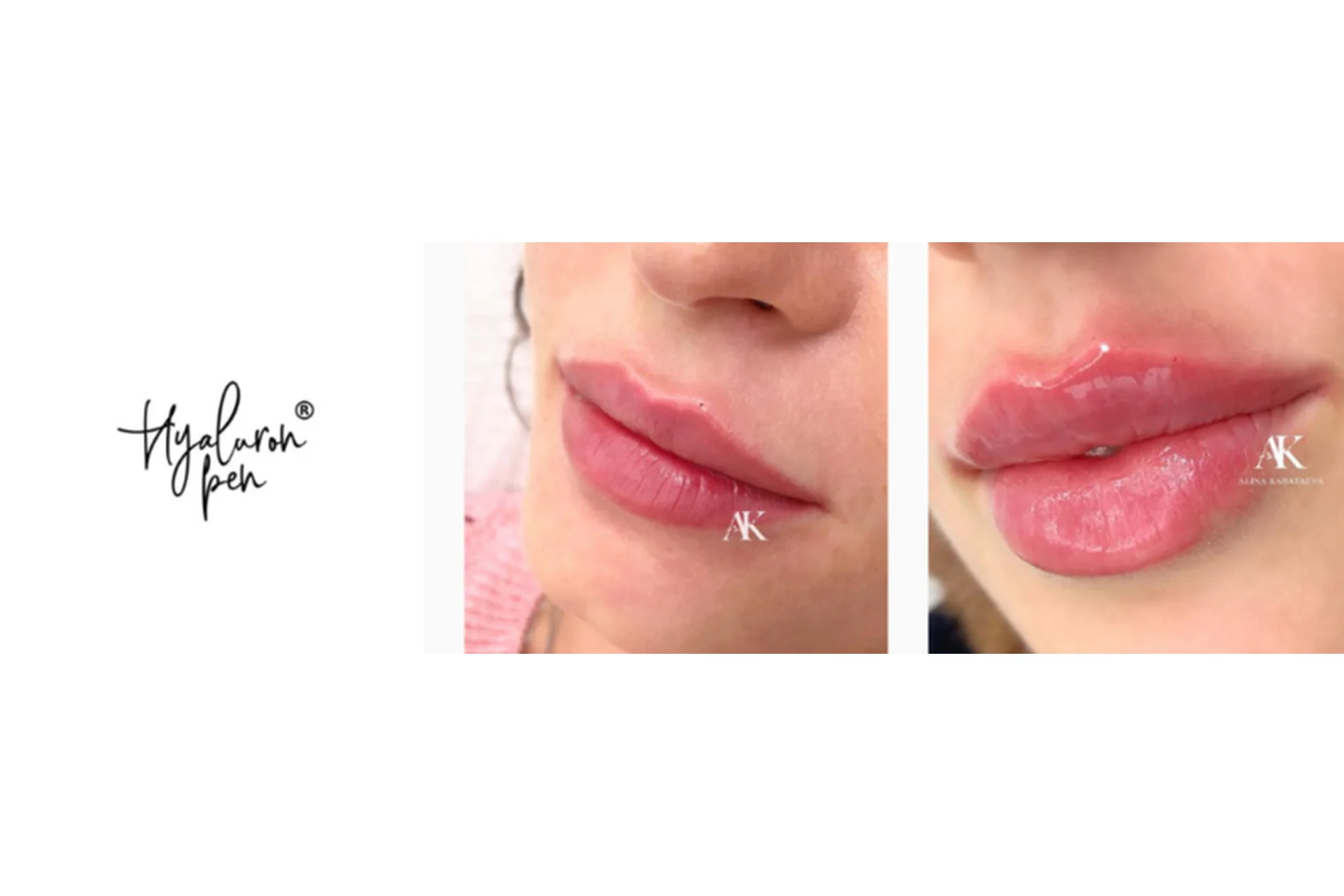 Hyaluron Pen. Все методики контурной пластики (Алина Каратаева), фото 1 из 1.