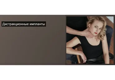 Дистракционные импланты (Дарья Хэнсон, Дмитрий Калинкин)