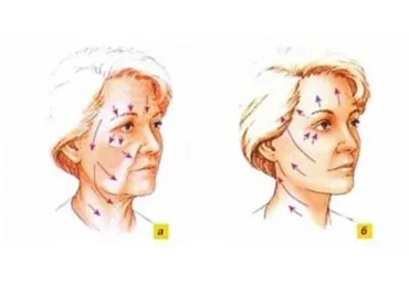 Эстетический реоформинг и кинезиотейпинг лица (Евгений Литвиченко)