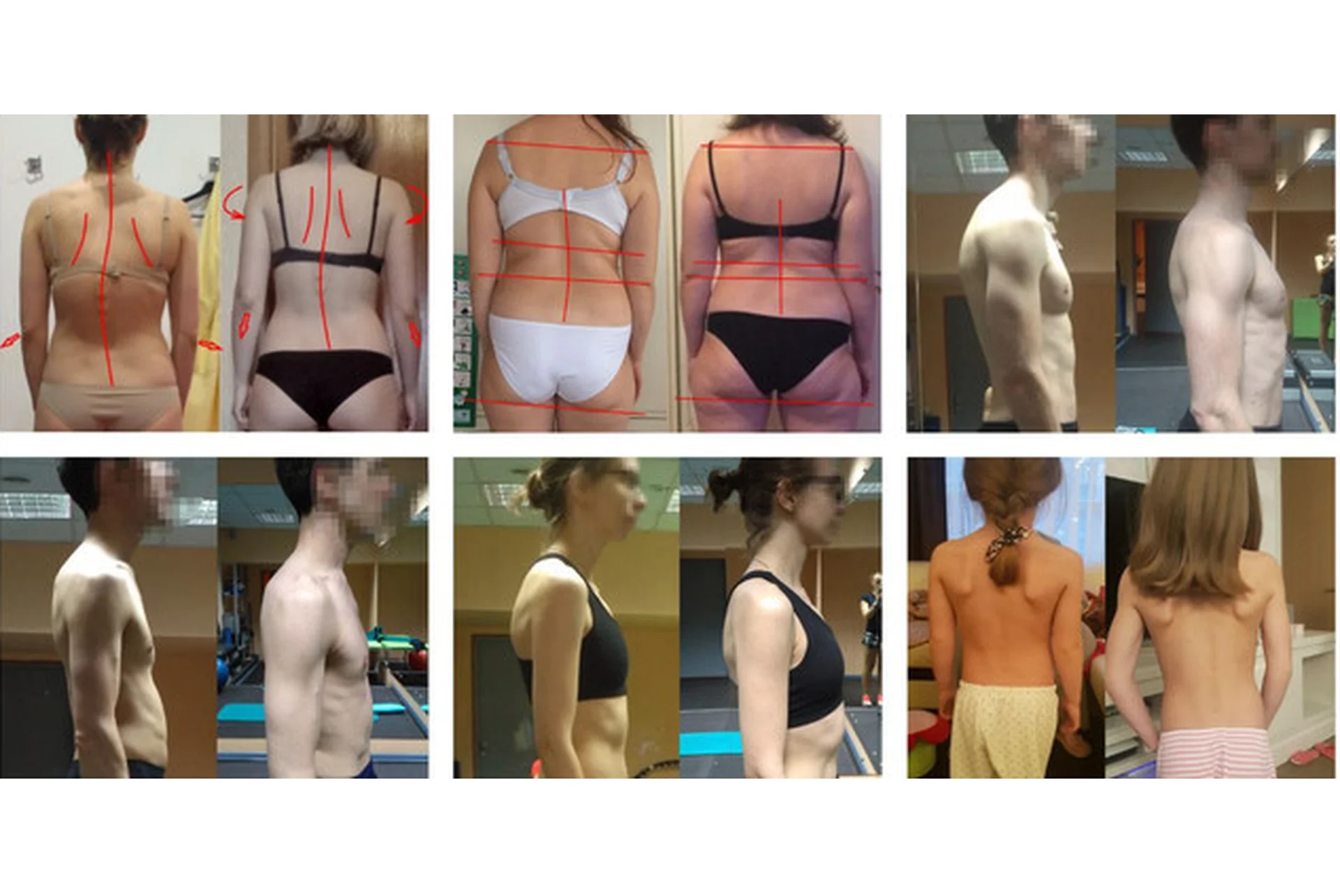 [SmartSpine] Распространенные проблемы ОДА: диагностика и коррекция (Ольга Бурова), фото 1 из 1.