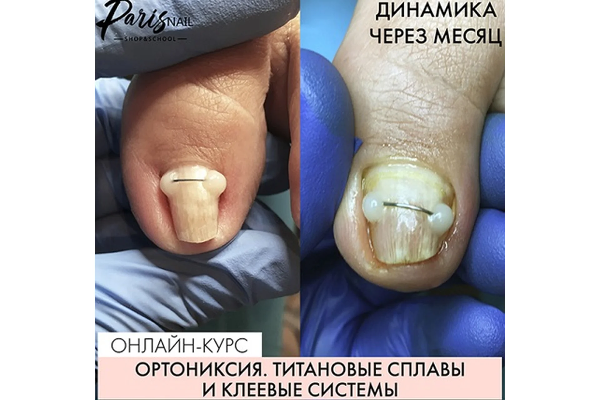 [ParisNail] Ортониксия. Титановые сплавы и клеевые системы (Карина Шурыгина), фото 1 из 1.