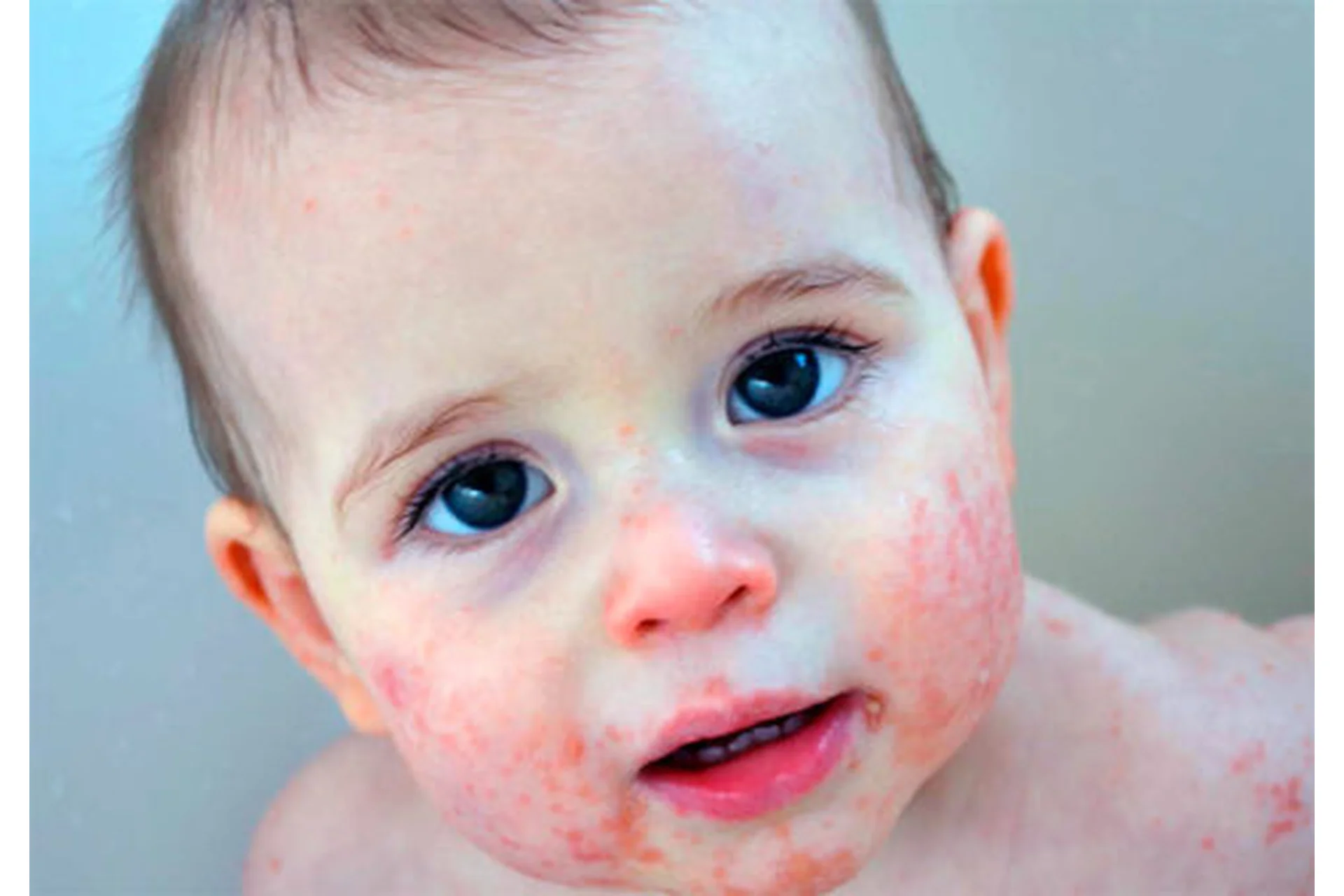 [Regina Doctor] Атопический дерматит (Регина Ахуньянова), фото 1 из 1.