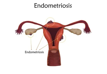 Проект "Эндометриоз" (Юлия Шефова)