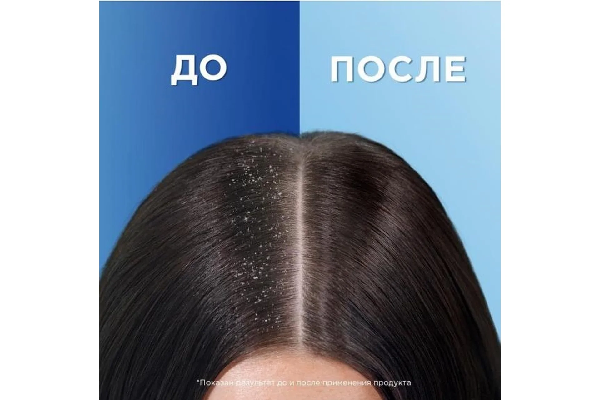 Избавляемся от перхоти за 1 раз, фото 1 из 1.