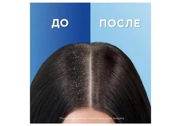 Избавляемся от перхоти за 1 раз