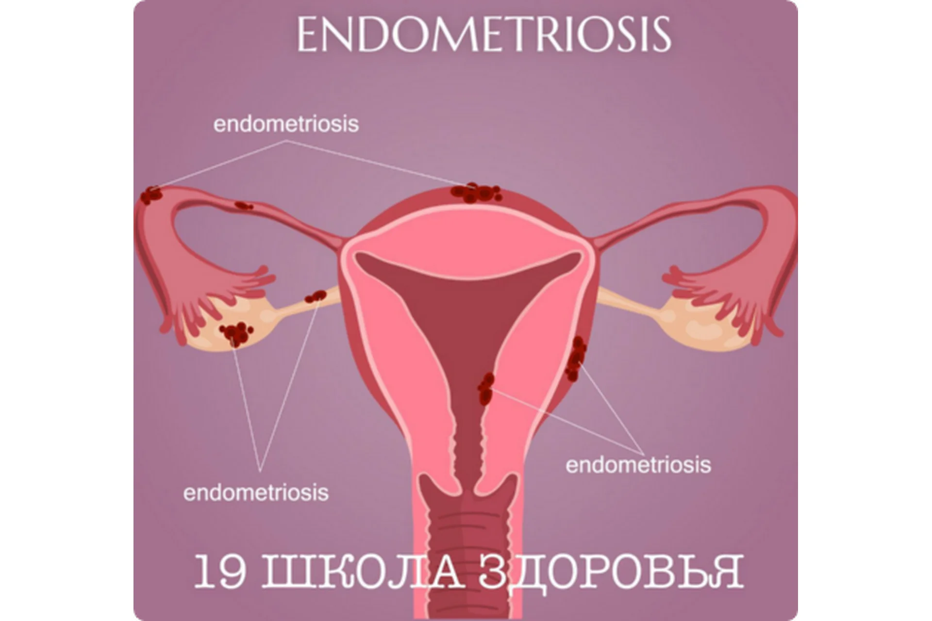 19 школа здоровья. Эндометриоз. Базовый (Галa Гарбузова), фото 1 из 1.