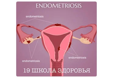 19 школа здоровья. Эндометриоз. Базовый (Галa Гарбузова)