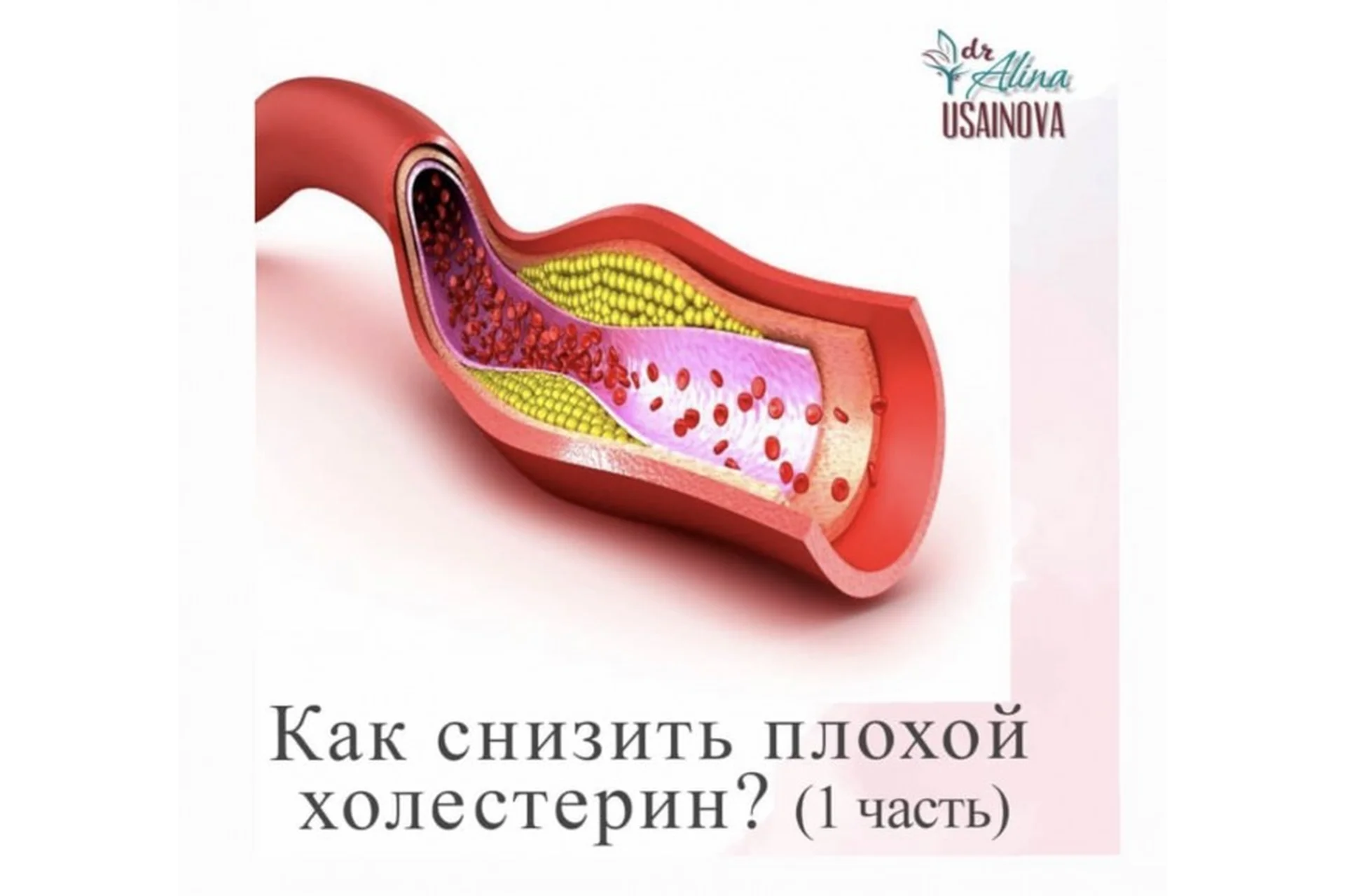 Как снизить плохой холестерин? 1 часть (Алина Усаинова), фото 1 из 1.