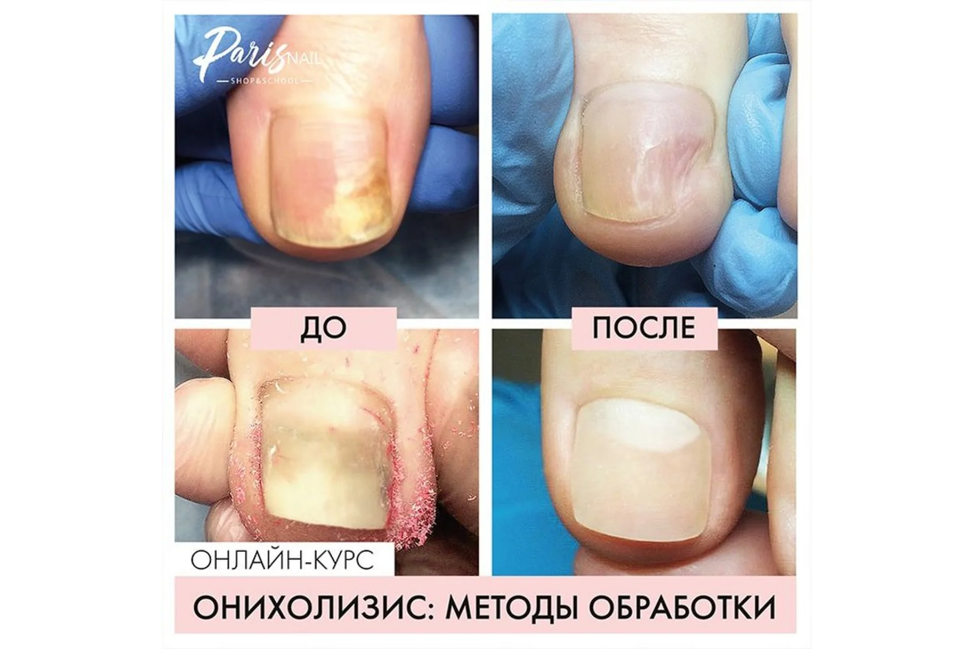 [Parisnail] Онихолизис: методы обработки. Август, 2019 (Карина Шурыгина), фото 1 из 1.