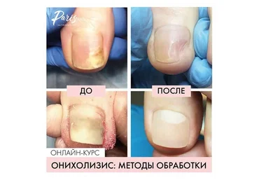 [Parisnail] Онихолизис: методы обработки. Август, 2019 (Карина Шурыгина)