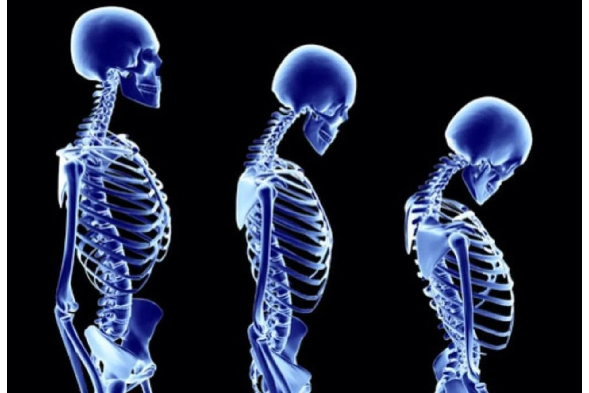 [Wellcom] Кифоз 3D: Протоколы реабилитационных тренировок при гиперкифозе  (Эльмира Хабибуллина), фото 1 из 1.