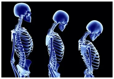 [Wellcom] Кифоз 3D: Протоколы реабилитационных тренировок при гиперкифозе  (Эльмира Хабибуллина)