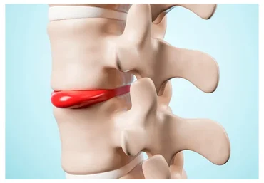 [Wellcom] Реабилитационный фитнес при межпозвонковых грыжах (Эльмира Хабибуллина)