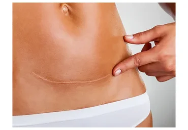 Работа с рубцами с помощью кинезио и кросс тейпирования (Валентин Гайт)