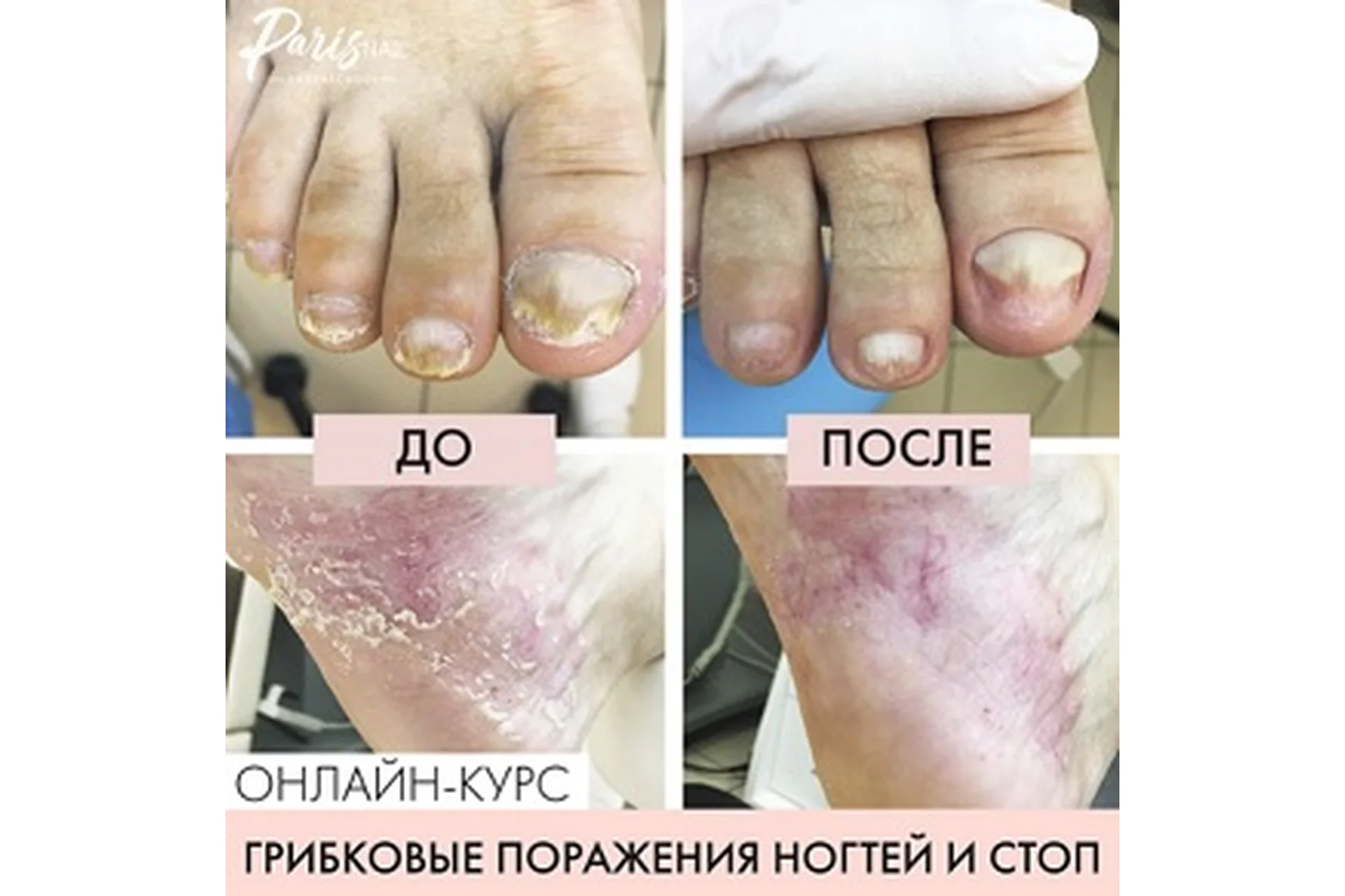 [parisnail] Грибковое поражение ногтей и кожи стоп (Карина Шурыгина), фото 1 из 1.