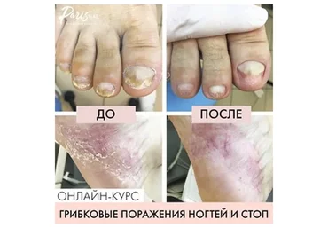 [parisnail] Грибковое поражение ногтей и кожи стоп (Карина Шурыгина)