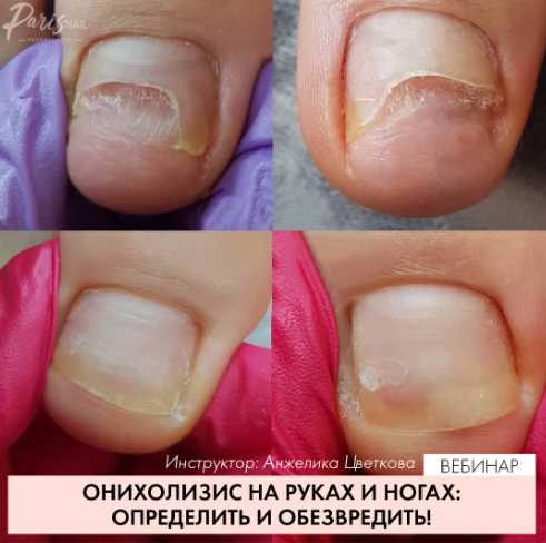 Вебинар Онихолизис  методы обработки август 2019 (Карина Шурыгина)