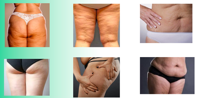 Клуб Здоровье: инструкция к применению. Целлюлит (Ольга Евдокимова)