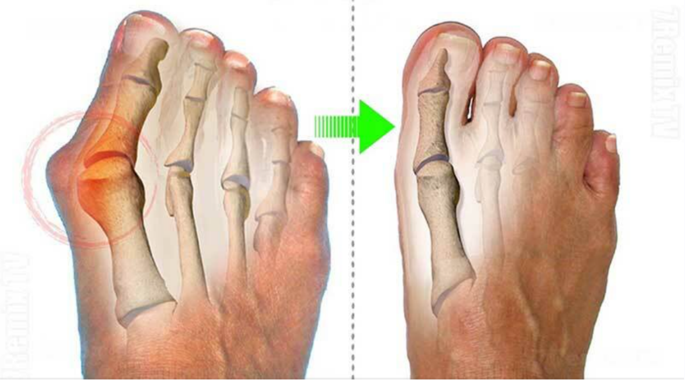 [Sigh Energy] Мощное исцеление бурсита плюс 11x (сверхсильный). Bunions Healing Powerful Plus +11x(Extra Strong)