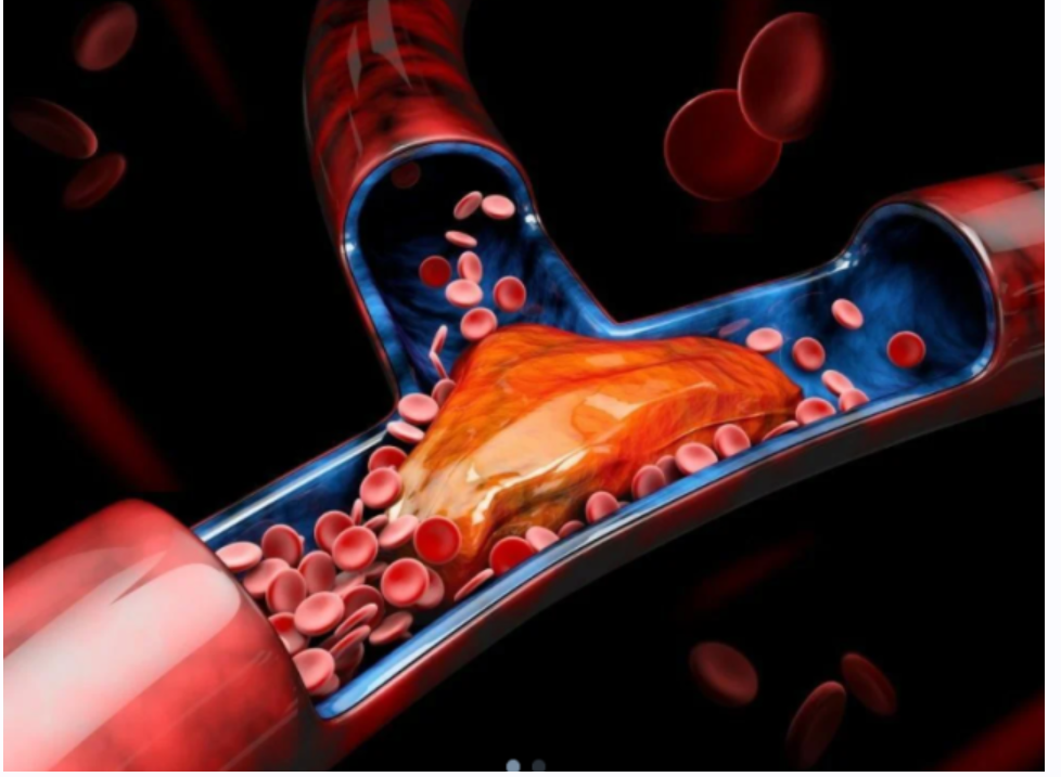 [Sigh Energy] Лечение тромбоза | Thrombosis Treatment Powerful Plus +11x (Extra Strong)