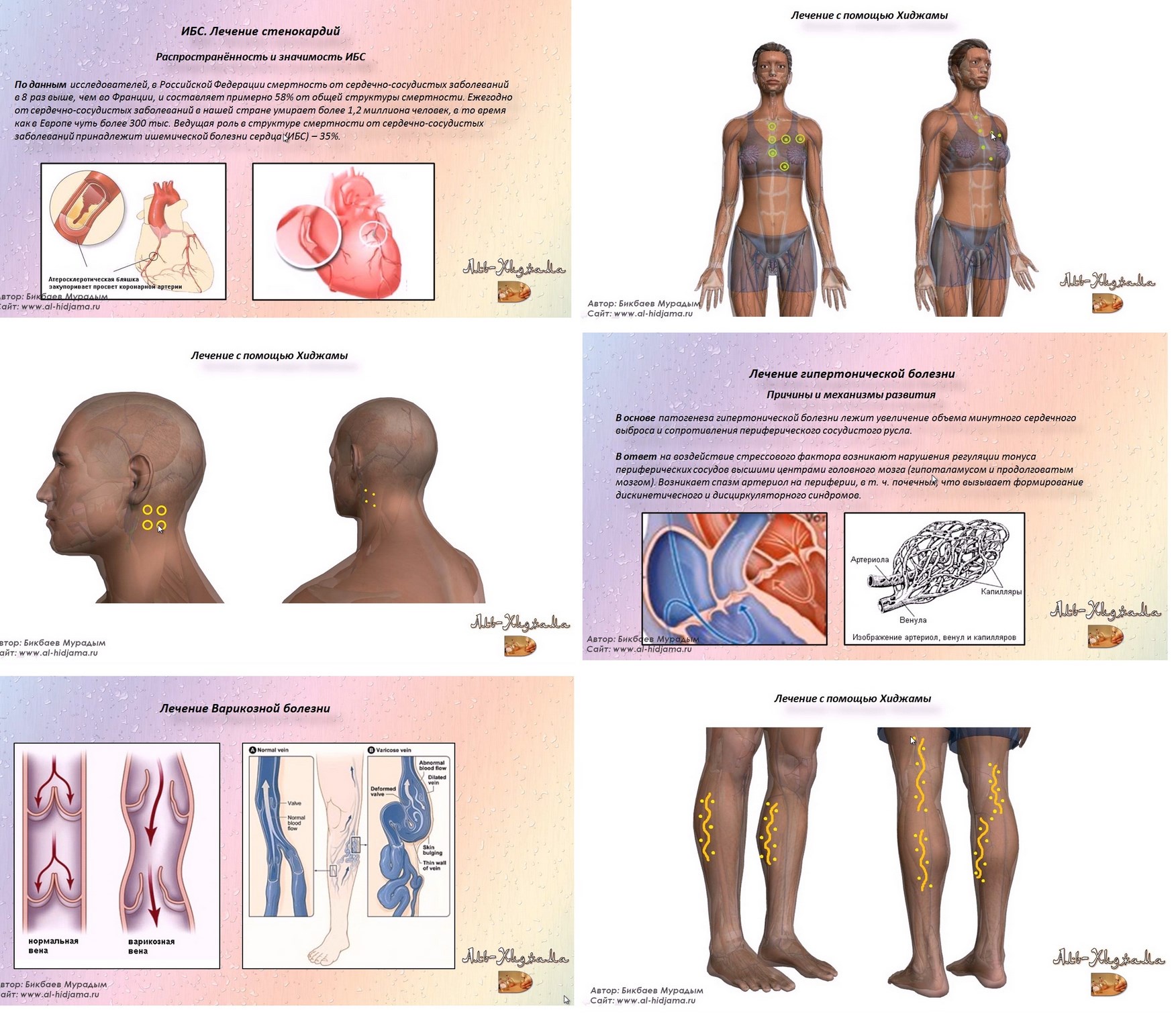 Хиджама. Практическое руководство (Мурадым Бикбаев)