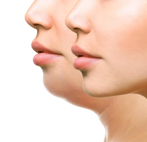 [Sigh Energy] Удаление двойного подбородка