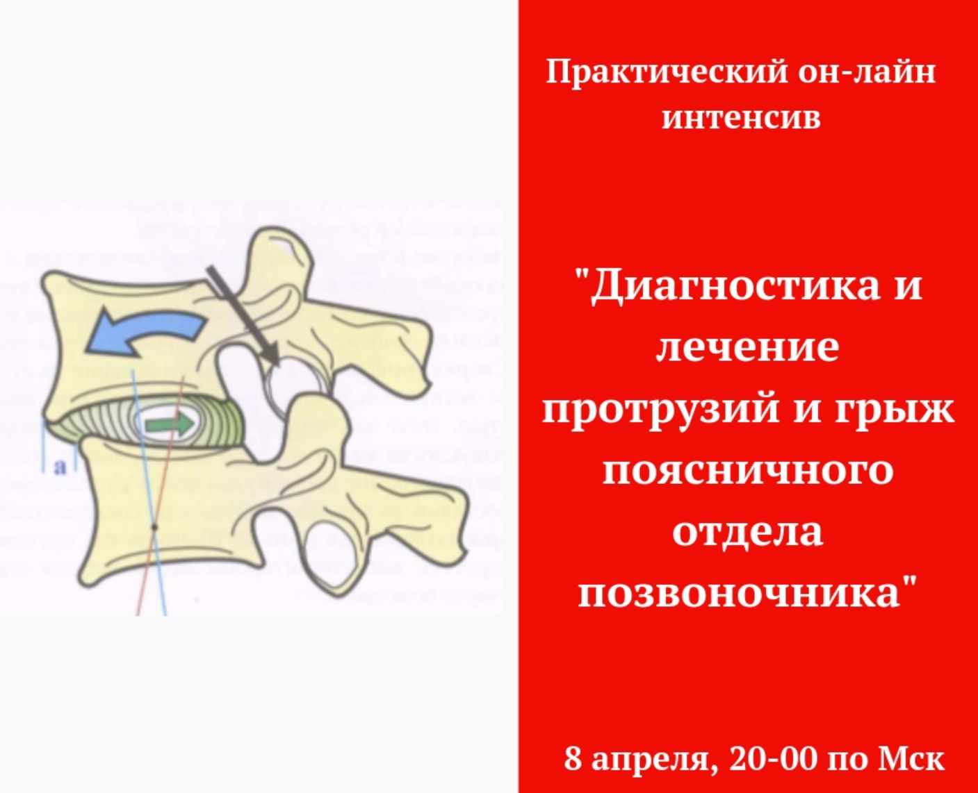 Диагностика и лечение грыж поясничного отдела (Игорь Атрощенко)