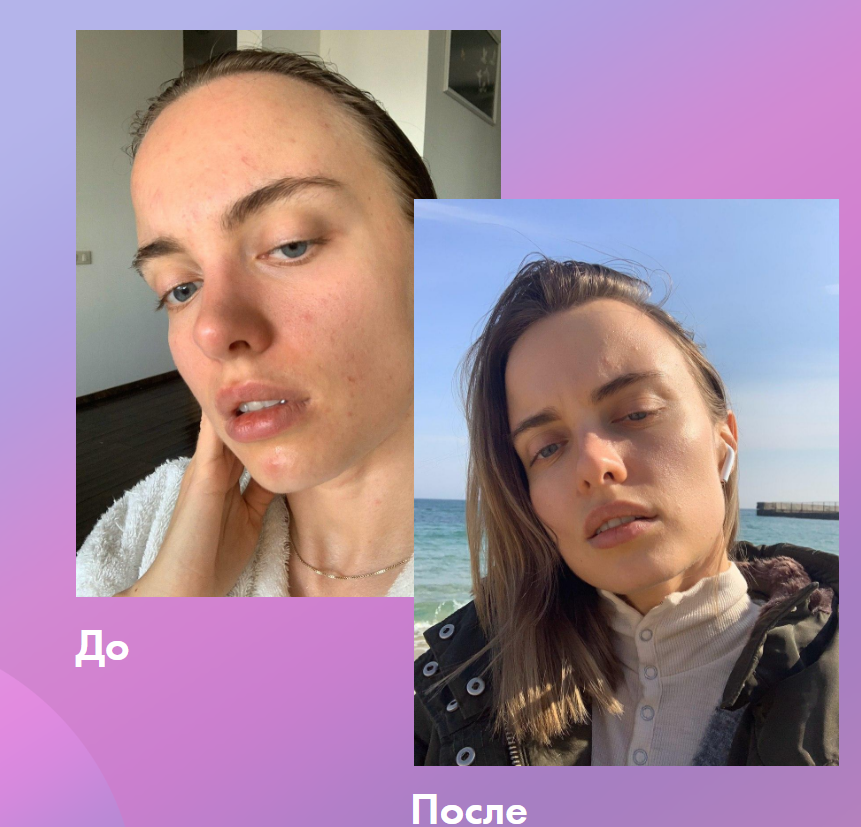 Вебинар «Акне» (Анна Капитанова)