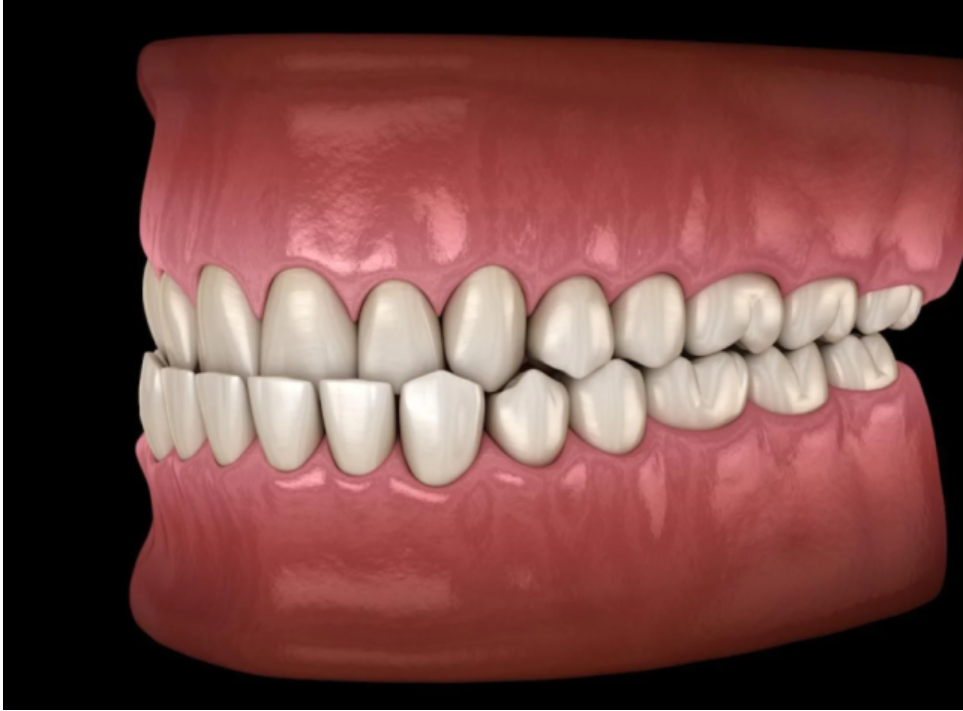 [Sigh Energy] Выравнивание прикуса | Bite Alignment Powerful Plus+11x (Extra Strong)