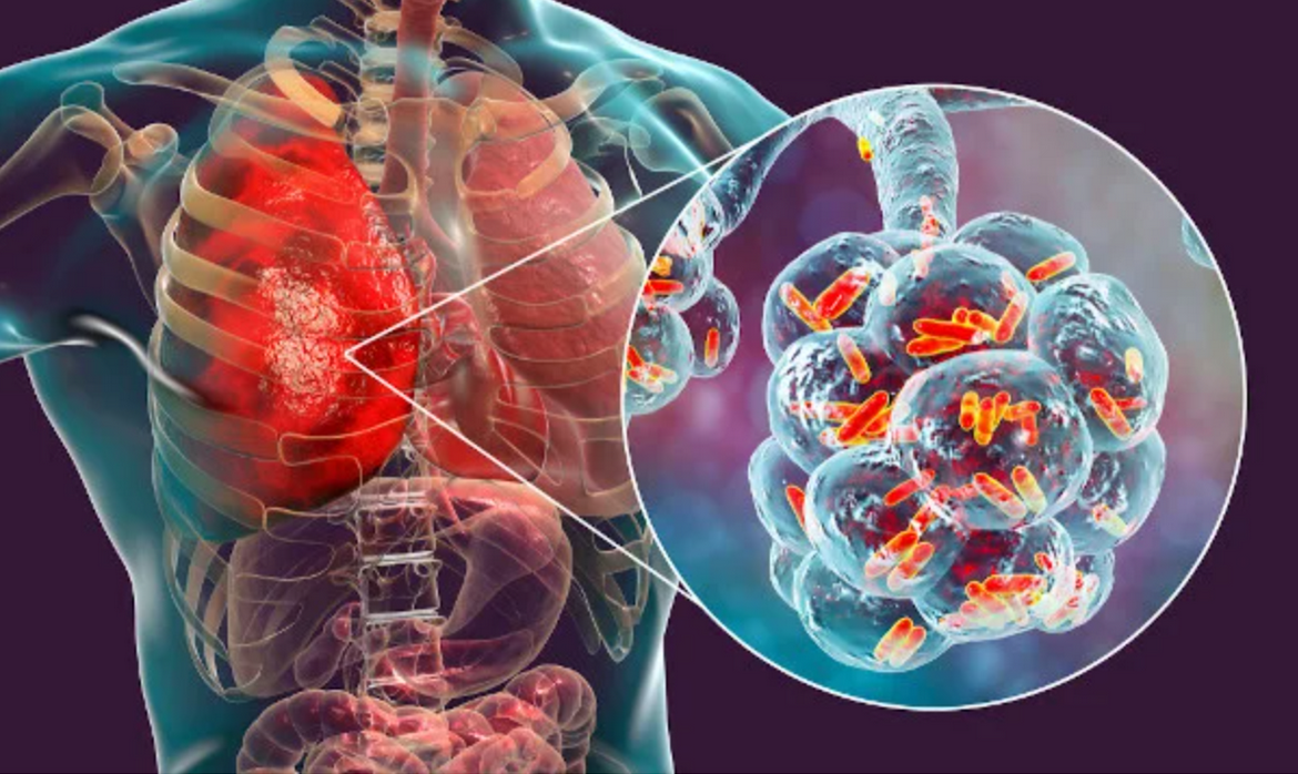 [Sigh Energy] Исцеление от пневмонии Powerful Plus + 11x (Extra Strong)