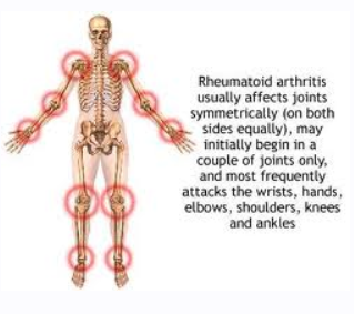 [Neuralsync] Освобождение от артрита, болях в мышцах и суставах