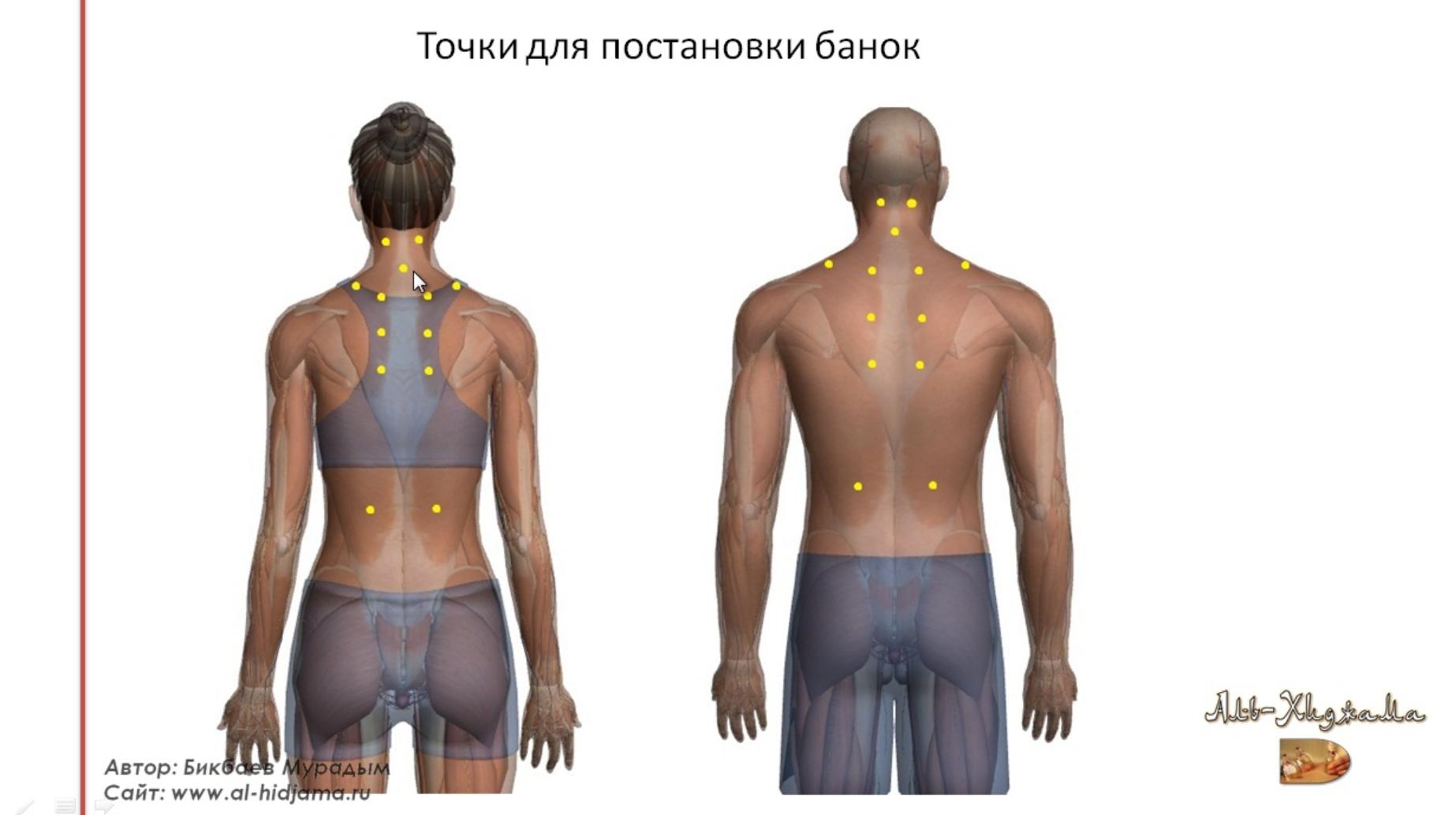 Хиджама в неврологии (Мурадым Бикбаев)