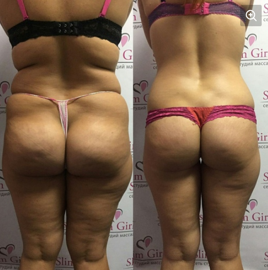 [Profflesson] Все виды антицеллюлитных жиросжигающих скульптурирующих массажей