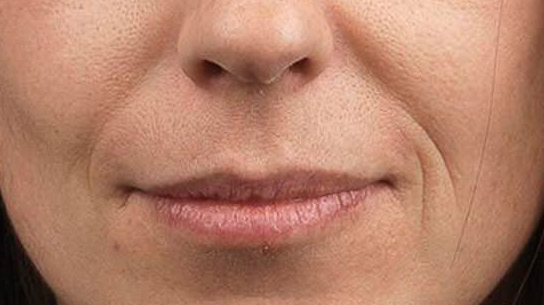 Как убрать носогубные морщины,"брыли",второй подбородок,подтянуть обвисшие щёки (Алена Россошинская), фото 1 из 1.