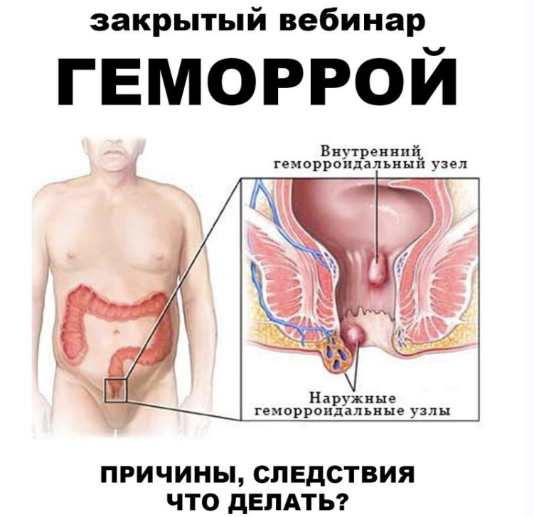[Школа Разумного Покупателя] Геморрой (Женя Братишка, Юля Братишка)