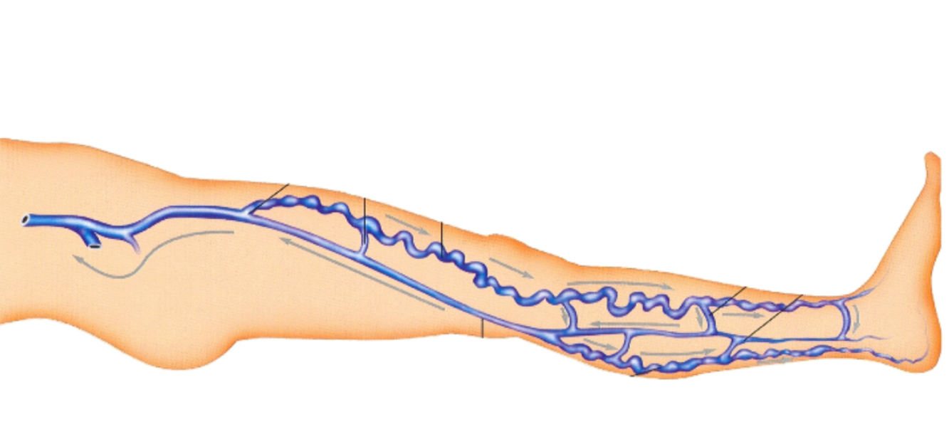 [Sigh Energy] Лечение варикозного расширения вен Powerful Plus + 11x (Extra Strong). Varicose veins healing Powerful Plus +11x(Extra Strong)