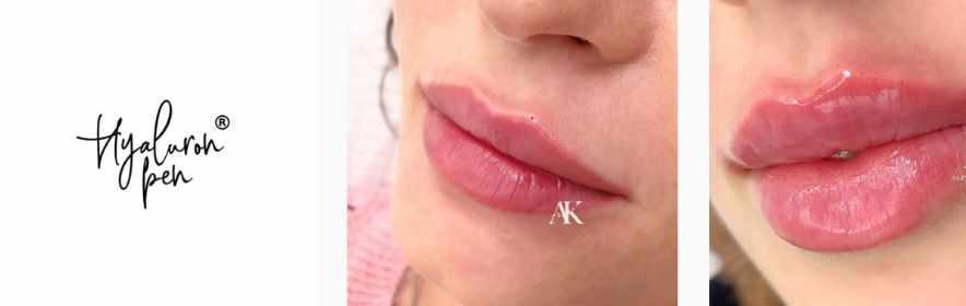 Полный курс Hyaluron Pen (гиалурон пен) Все методики контурной пластики (Алина Каратаева)