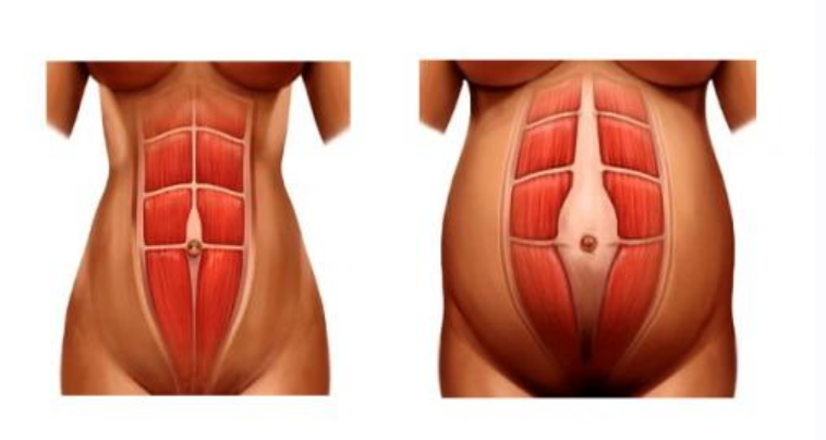 [Wellcom] Коррекция диастаза, восстановление функции мышц тазового дна (Диляра Ахмадуллина)