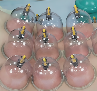 [ККПК] Вакуумно-баночная терапия при болевом синдроме (Александр Сокун)