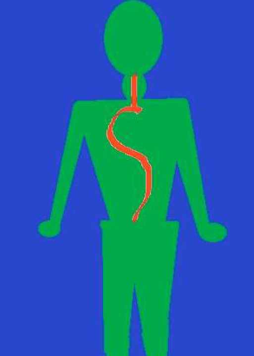 Лечение сколиоза Рейки (Линда Колиберт, Дейлин Вульф)