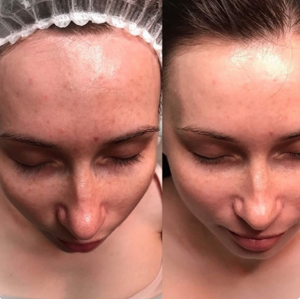 Молочный пилинг (natur.cosmetica)