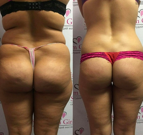 [Profflesson] Все виды антицеллюлитных жиросжигающих скульптурирующих массажей. Тариф Дистанционно